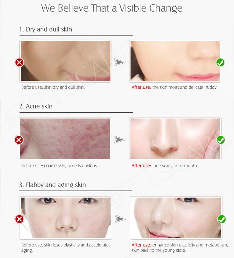 ARTISCARE Sérum de Vitamina C para el Rostro Hidratante 4 Piezas Ácido Hialurónico Cuidado Facial Esencia Nutritiva Productos para el Cuidado de la Piel